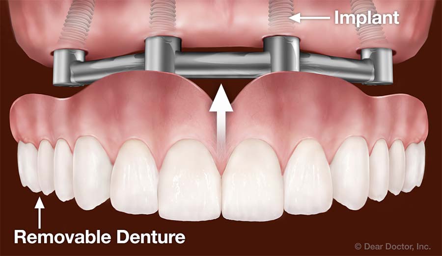 Dental Implants Support Removable Dentures.