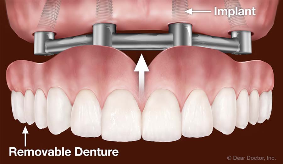 Dental Implants Support Removable Dentures.